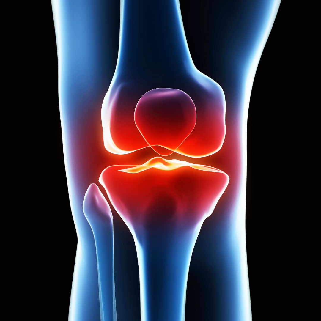 What is a custom-made knee replacement prosthesis?