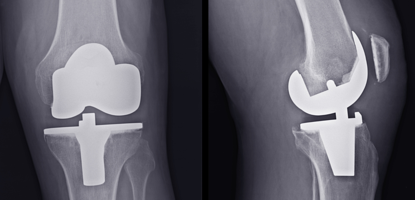Операция по эндопротезированию коленного сустава. Замена коленного сустава рентген. Операция по замене коленного сустава москва