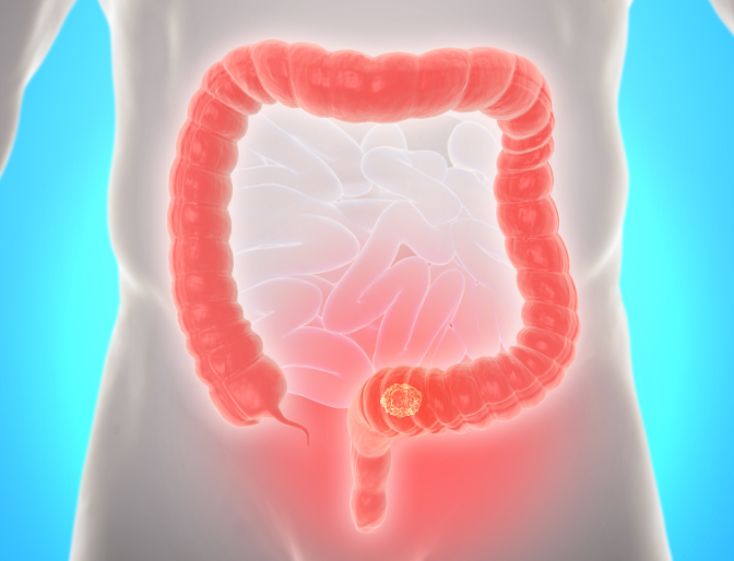 What does bowel screening test for?