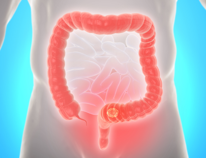 What does bowel cancer screening test for?