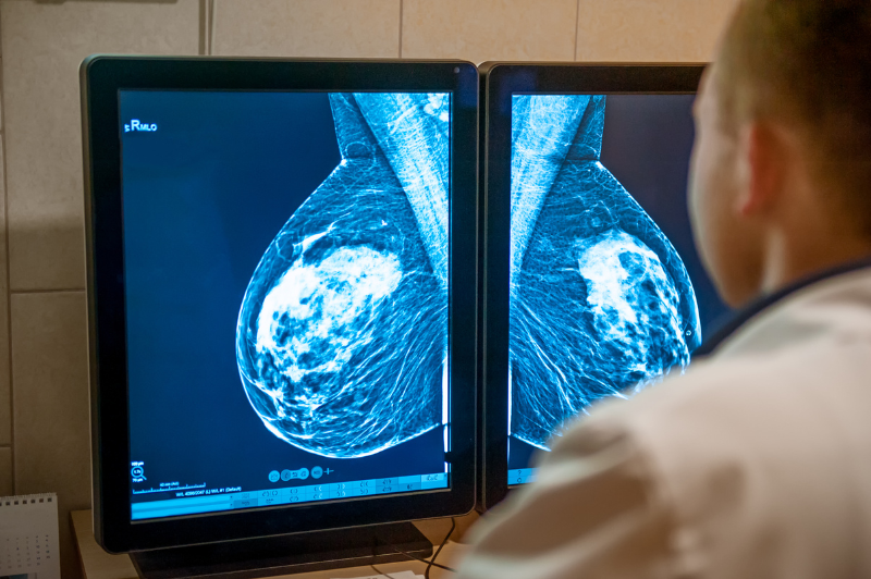 Mammogram