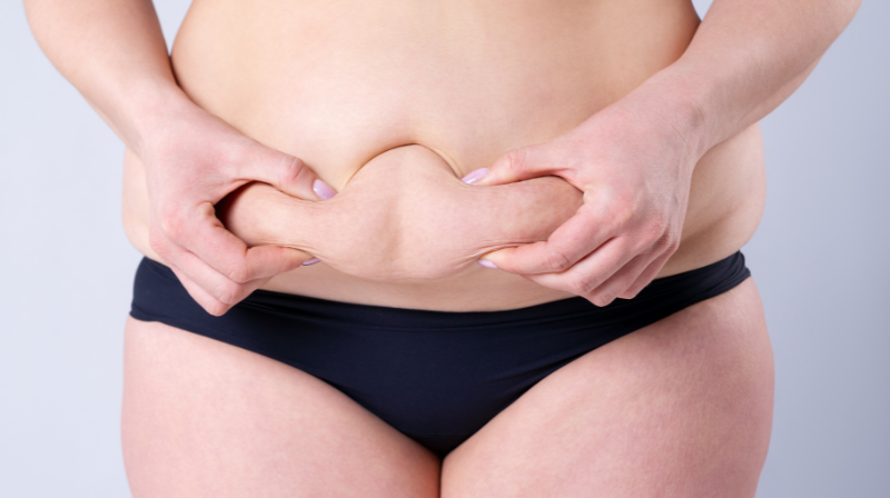 What is a tummy tuck?