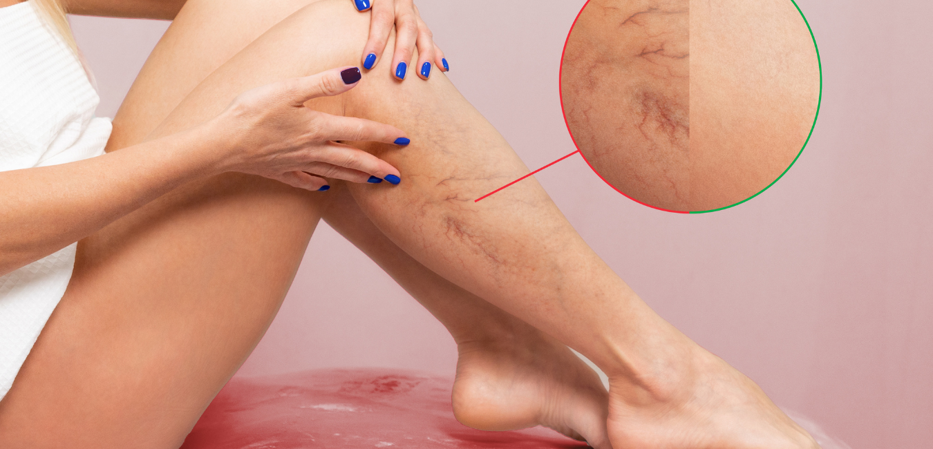 Varicose Vein Removal Chelmsford