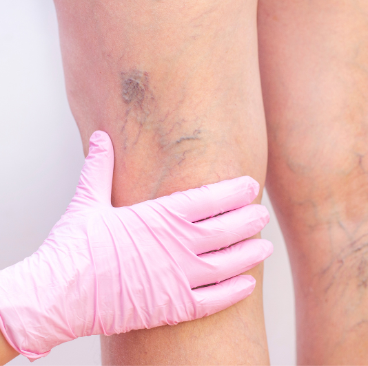 What causes varicose veins?