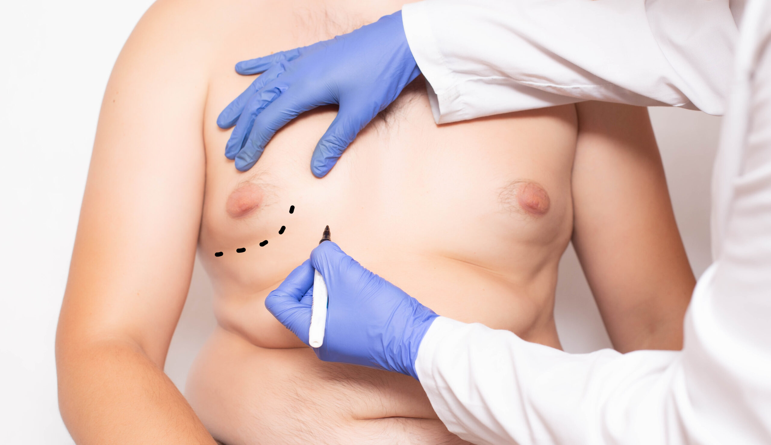 Is male chest reduction surgery right for me?